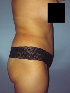 Tummy Tuck Before and After Pictures in Miami, FL