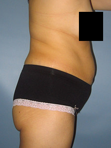 Tummy Tuck Before and After Pictures in Miami, FL