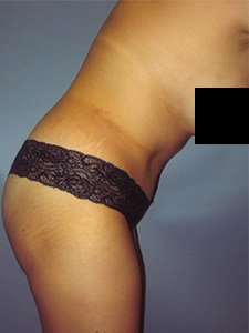 Tummy Tuck Before and After Pictures in Miami, FL