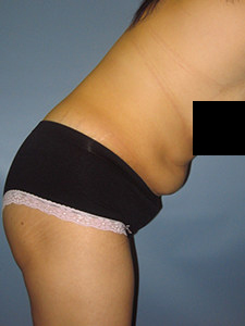 Tummy Tuck Before and After Pictures in Miami, FL