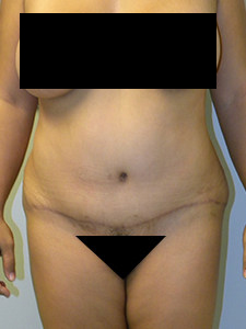 Tummy Tuck Before and After Pictures in Miami, FL