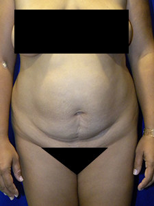 Tummy Tuck Before and After Pictures in Miami, FL