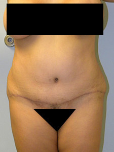 Tummy Tuck Before and After Pictures in Miami, FL