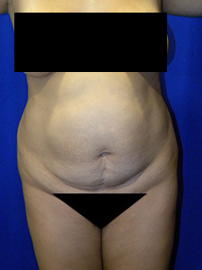 Tummy Tuck Before and After Pictures in Miami, FL