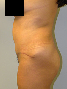 Tummy Tuck Before and After Pictures in Miami, FL