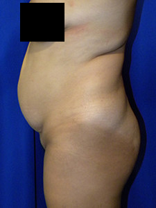 Tummy Tuck Before and After Pictures in Miami, FL