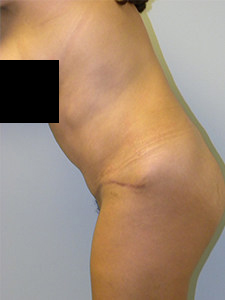 Tummy Tuck Before and After Pictures in Miami, FL