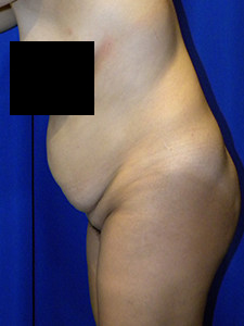 Tummy Tuck Before and After Pictures in Miami, FL