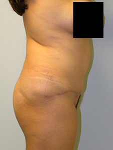 Tummy Tuck Before and After Pictures in Miami, FL