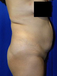 Tummy Tuck Before and After Pictures in Miami, FL