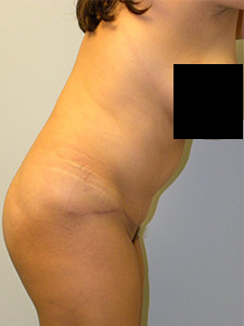 Tummy Tuck Before and After Pictures in Miami, FL