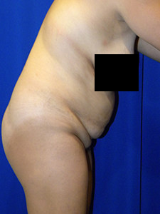 Tummy Tuck Before and After Pictures in Miami, FL