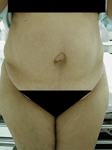 Tummy Tuck Before and After Pictures Miami, FL