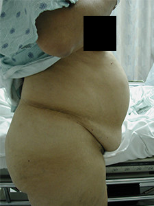 Tummy Tuck Before and After Pictures Miami, FL