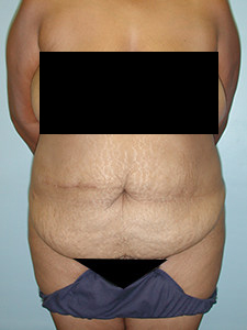 Tummy Tuck Before and After Pictures Miami, FL