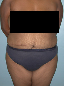 Tummy Tuck Before and After Pictures Miami, FL