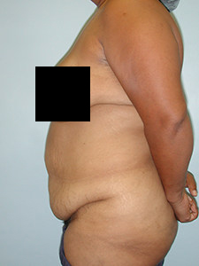 Tummy Tuck Before and After Pictures Miami, FL