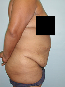 Tummy Tuck Before and After Pictures Miami, FL