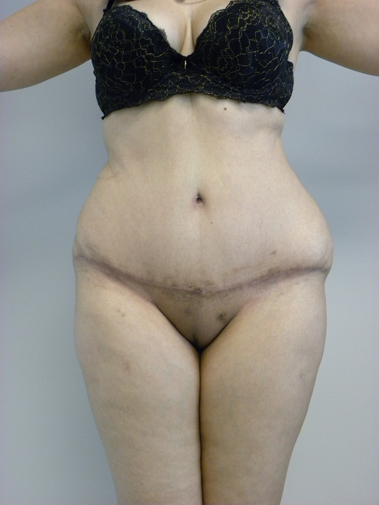 Tummy Tuck Before and After Pictures in Miami, FL