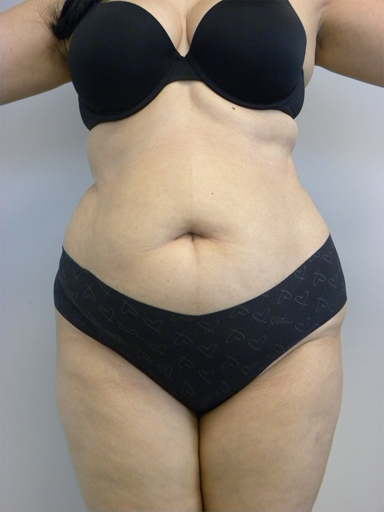 Tummy Tuck Before and After Pictures in Miami, FL