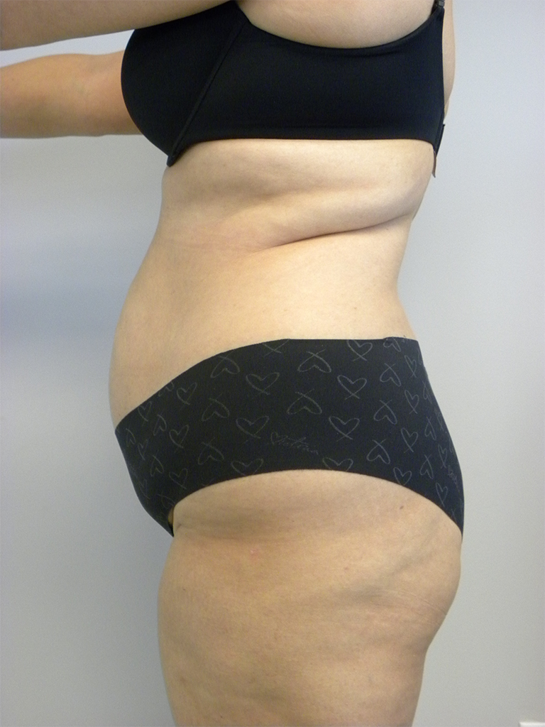 Tummy Tuck Before and After Pictures in Miami, FL