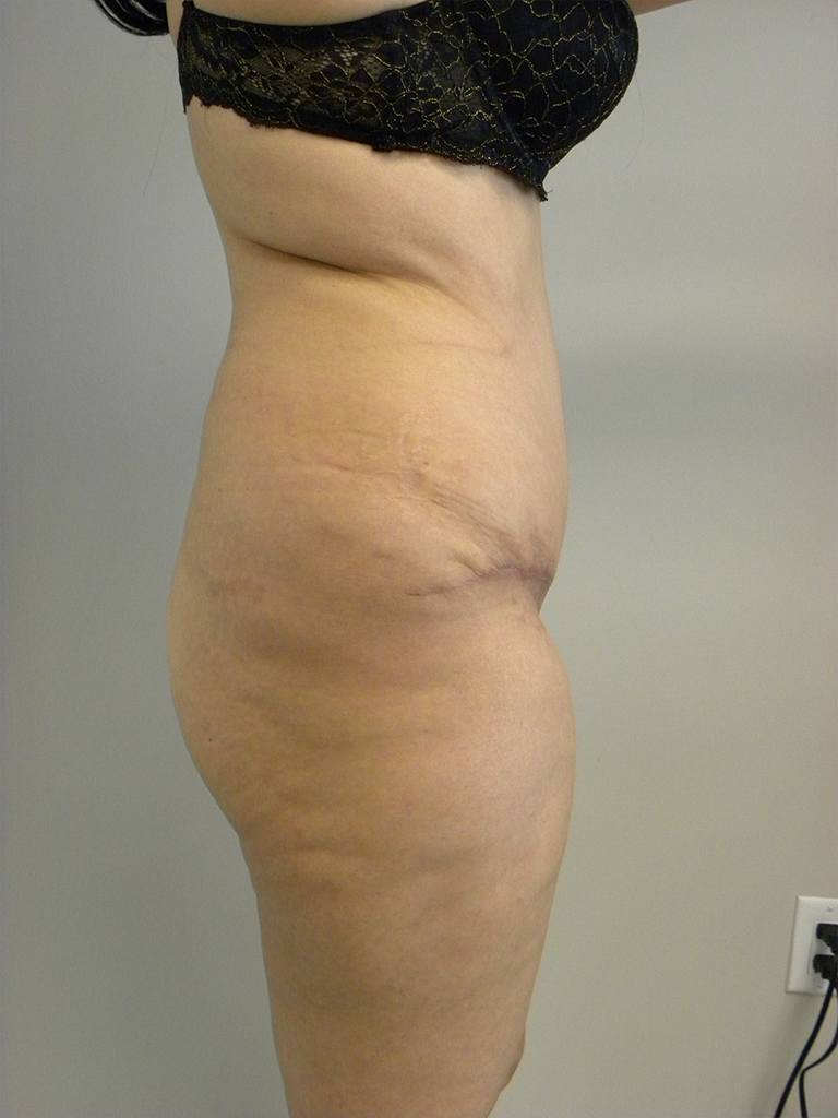 Tummy Tuck Before and After Pictures in Miami, FL