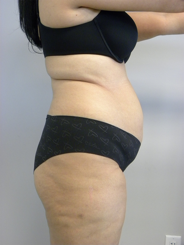 Tummy Tuck Before and After Pictures in Miami, FL