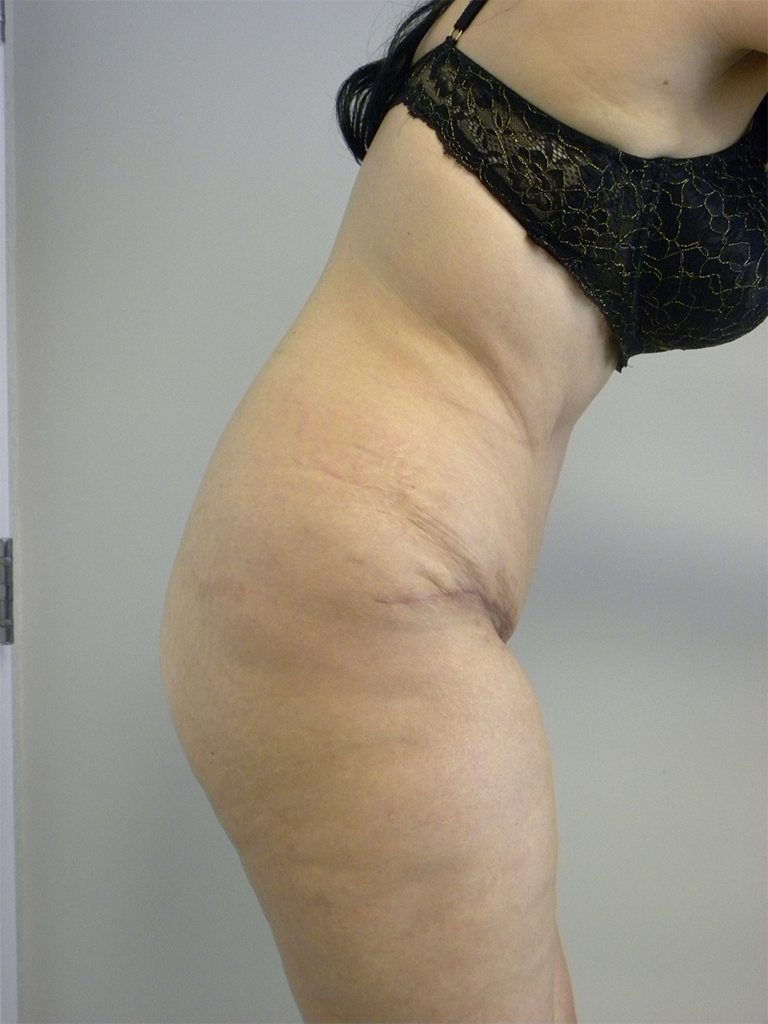 Tummy Tuck Before and After Pictures in Miami, FL