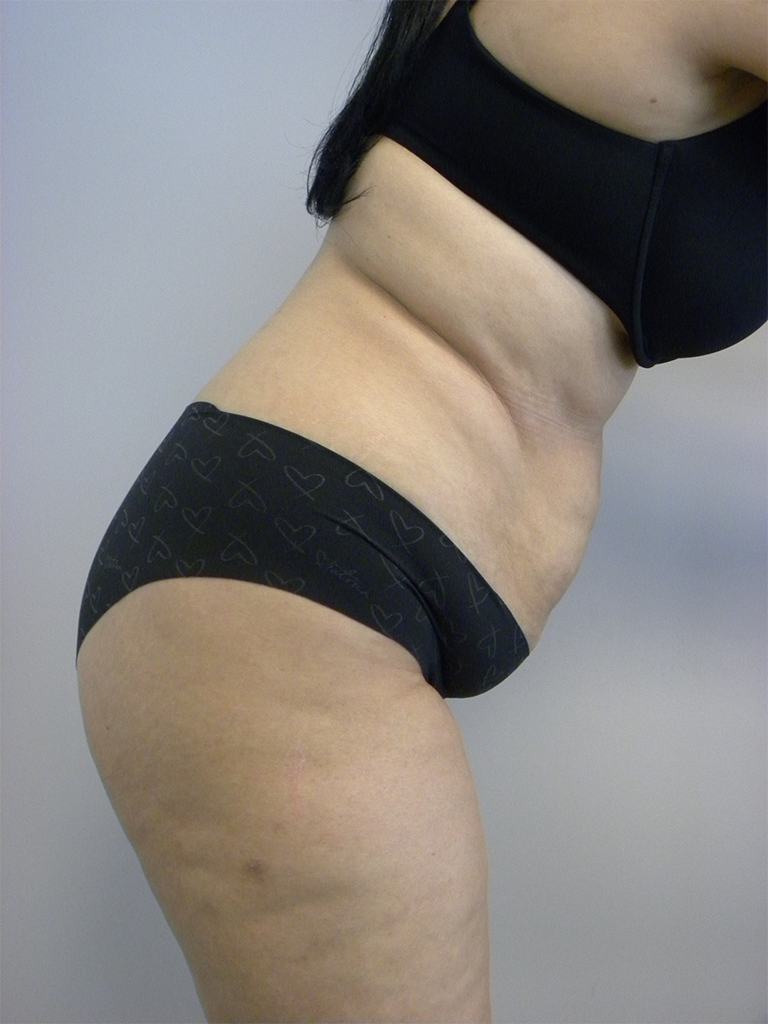 Tummy Tuck Before and After Pictures in Miami, FL