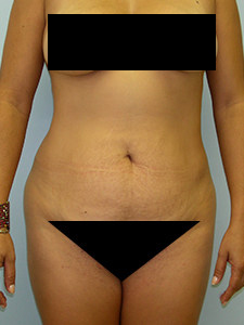 Tummy Tuck Before and After Pictures Miami, FL