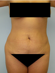 Tummy Tuck Before and After Pictures Miami, FL