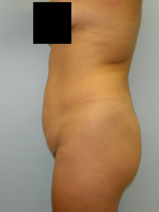 Tummy Tuck Before and After Pictures Miami, FL