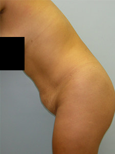 Tummy Tuck Before and After Pictures in Miami, FL