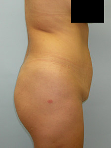 Tummy Tuck Before and After Pictures Miami, FL