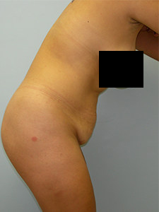 Tummy Tuck Before and After Pictures Miami, FL