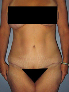 Tummy Tuck Before and After Pictures in Miami, FL