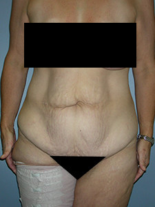 Tummy Tuck Before and After Pictures in Miami, FL