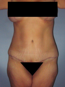 Tummy Tuck Before and After Pictures in Miami, FL