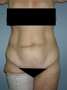 Tummy Tuck Before and After Pictures in Miami, FL