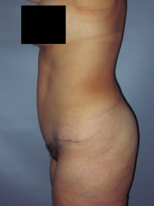 Tummy Tuck Before and After Pictures in Miami, FL