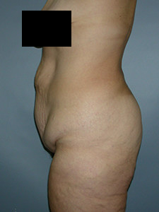 Tummy Tuck Before and After Pictures in Miami, FL