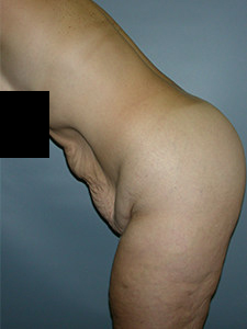 Tummy Tuck Before and After Pictures in Miami, FL