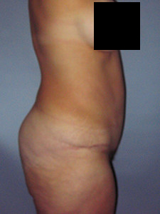 Tummy Tuck Before and After Pictures in Miami, FL