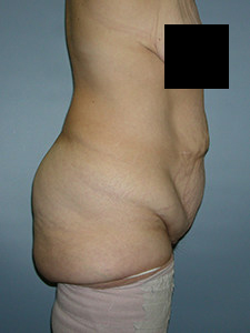 Tummy Tuck Before and After Pictures in Miami, FL