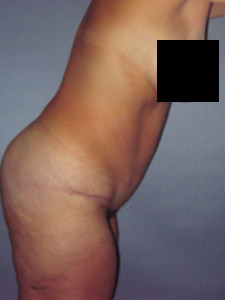 Tummy Tuck Before and After Pictures in Miami, FL