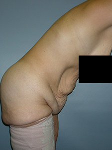 Tummy Tuck Before and After Pictures in Miami, FL