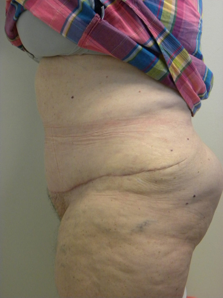 Tummy Tuck Before and After Pictures Miami, FL