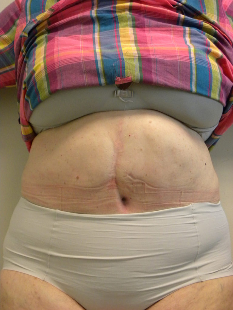 Tummy Tuck Before and After Pictures Miami, FL