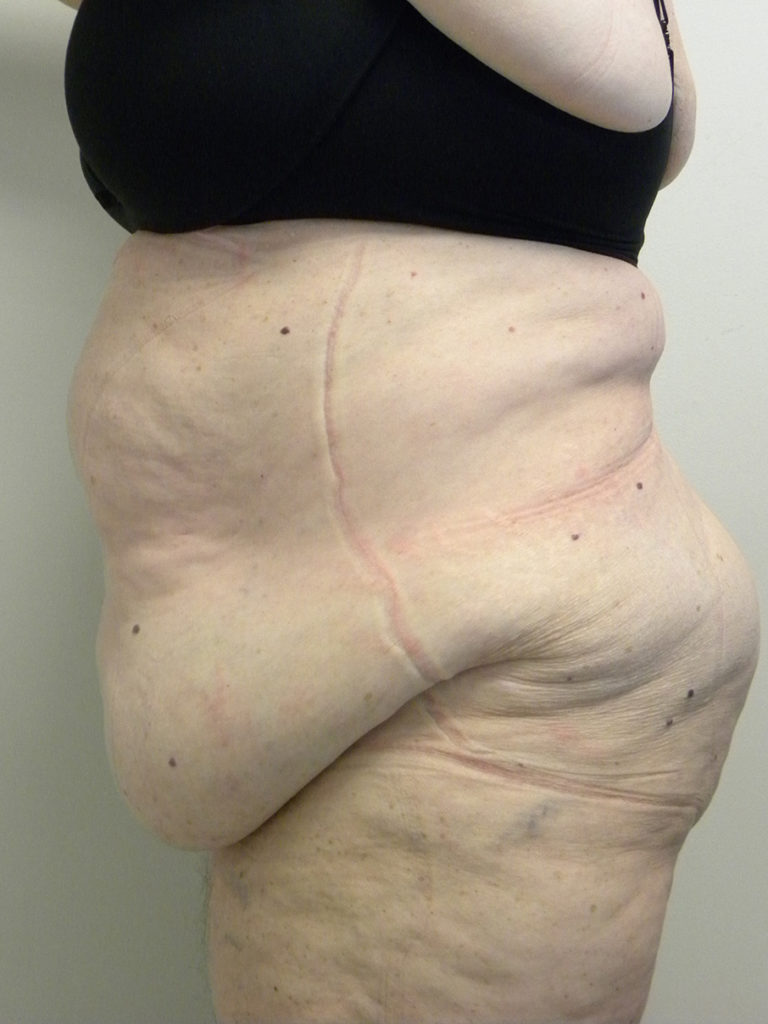 Tummy Tuck Before and After Pictures Miami, FL