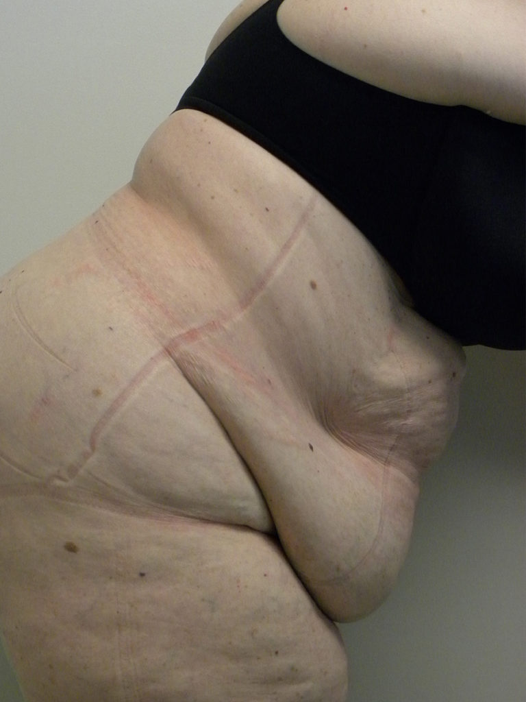 Tummy Tuck Before and After Pictures Miami, FL